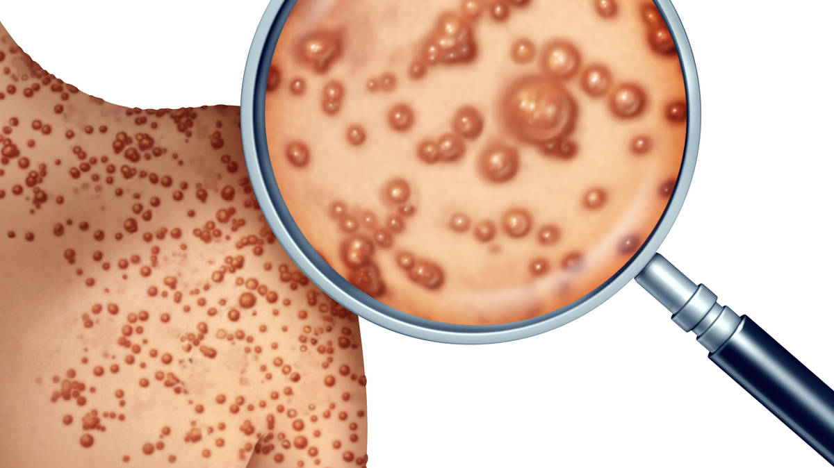 US declares public health emergency over monkeypox outbreak | LBC