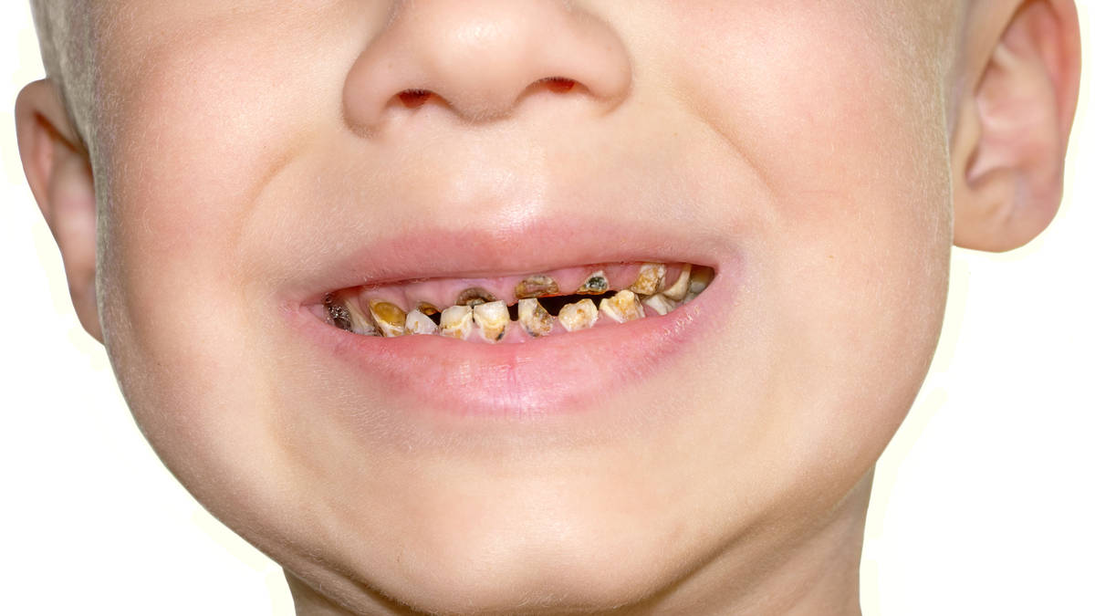 North-south divide as data shows amount of children with rotting teeth ...