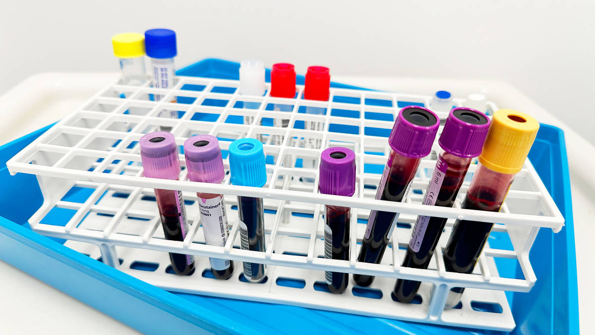 Measles Deaths: Two Children Die in England This Year
